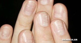 Τι Δείχνουν τα Λευκά Σημάδια στα Νύχια για την Υγεία Μας