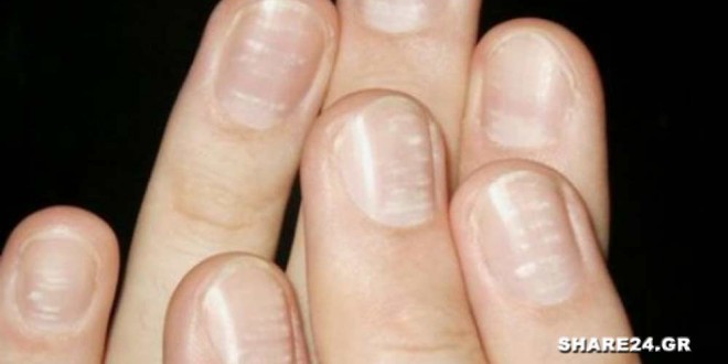 Τι Δείχνουν τα Λευκά Σημάδια στα Νύχια για την Υγεία Μας
