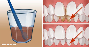 Αφαιρέστε την Πέτρα, Καθαρίστε την Πλάκα & Αντιμετωπίστε τα Βακτήρια του Στόματος με Αυτά τα Φυσικά Συστατικά