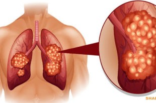 8 Σημάδια που Προειδοποιούν για τον Καρκίνο του Πνεύμονα και Πρέπει να Γνωρίζετε