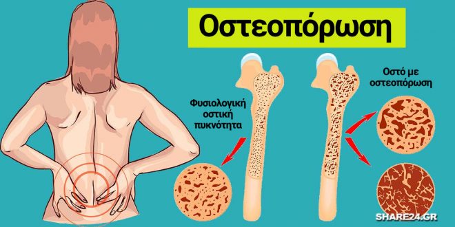 13 Τρόποι για να Σταματήσετε την Οστεοπόρωση και να Ενισχύσετε τα Οστά Σας !